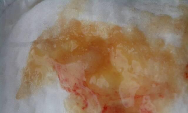 尿中出现血迹，你需要了解的原因和应对方法(图2)