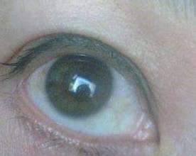 揭秘眼白混浊的原因（探寻眼白混浊形成的根源和解决方法）(图2)