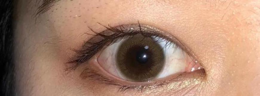 揭秘眼白混浊的原因（探寻眼白混浊形成的根源和解决方法）(图3)