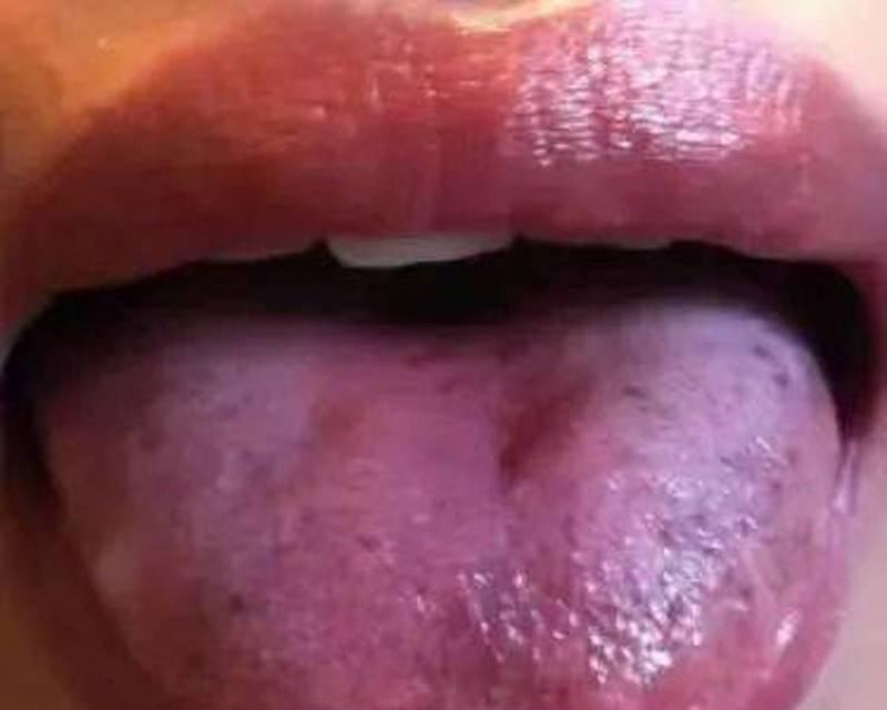 舌苔颜色的意义及影响（舌苔颜色的正常范围及可能的健康问题）(图2)