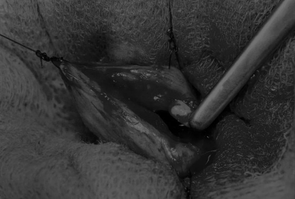 8张图带你解锁新技能——膀胱切开术（附手术视频）(图4)