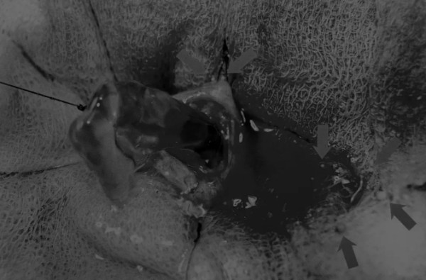 8张图带你解锁新技能——膀胱切开术（附手术视频）(图5)