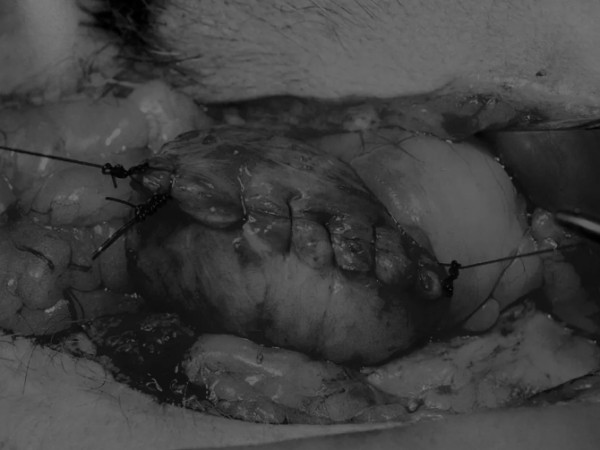 8张图带你解锁新技能——膀胱切开术（附手术视频）(图8)