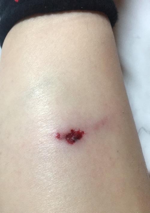 如何处理狗狗被咬伤的皮肤问题(家庭应急处理方法与注意事项)(图2) 如何处理狗狗被咬伤的皮肤问题(家庭应急处理方法与注意事项)(图2)