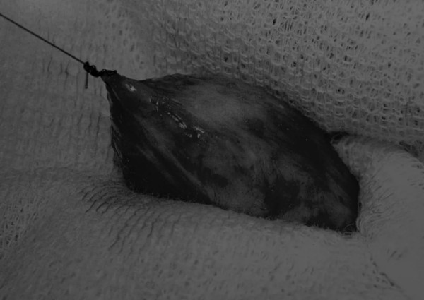 8张图带你解锁新技能——膀胱切开术（附手