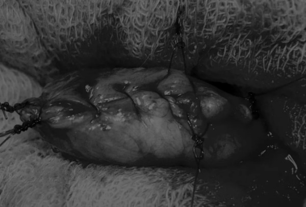 8张图带你解锁新技能——膀胱切开术（附手术视频）(图7)