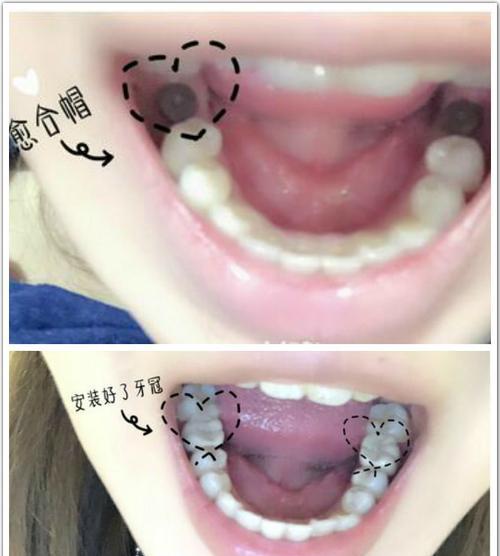 大牙的更替时机和保健方法（了解大牙更替的关键时期和正确的保健方法，保持口腔健康）(图2)
