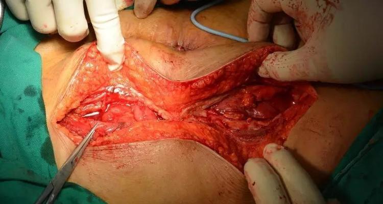 狗肠梗阻手术(了解狗肠梗阻手术后的恢复时间以及关键因素,让你的宠物更快康复)(图4) 狗肠梗阻手术(了解狗肠梗阻手术后的恢复时间以及关键因素,让你的宠物更快康复)(图4)