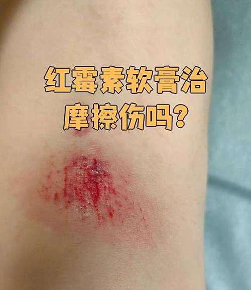 皮肤擦伤发炎应对指南（急救小知识，有效防范皮肤擦伤后的感染风险）(图1)