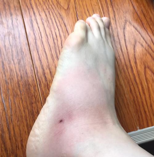 皮肤擦伤发炎应对指南（急救小知识，有效防范皮肤擦伤后的感染风险）(图2)