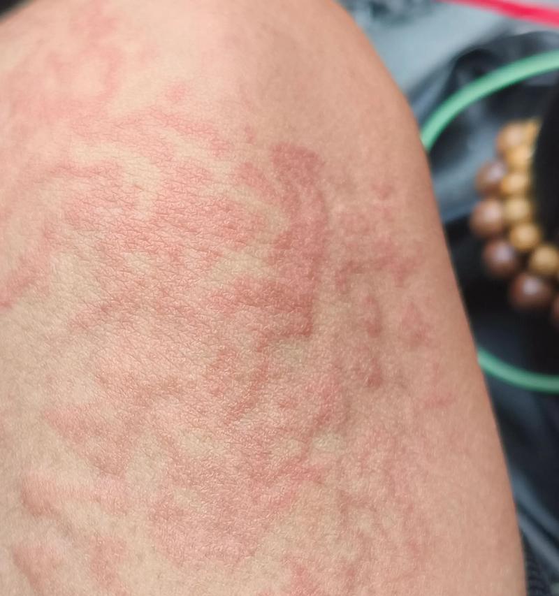 疫苗接种后出现过敏反应的原因与对策（了解疫苗接种后可能出现的过敏反应，做好预防和处理工作）(图1)