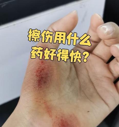 皮肤擦伤发炎应对指南（急救小知识，有效防范皮肤擦伤后的感染风险）(图3)