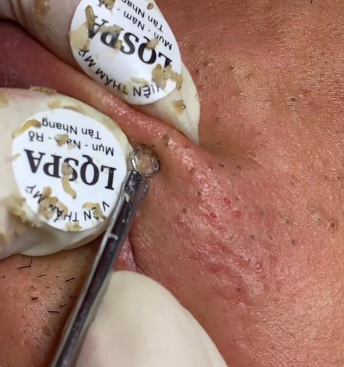 猫咪下巴黑头，是否可以挤破？（了解猫咪下巴黑头的成因及处理方法）(图3)